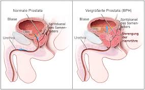 vorbeugen prostatakrebs